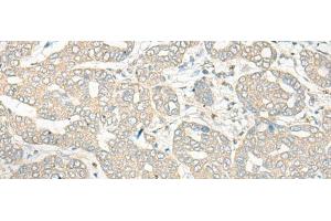 Immunohistochemistry of paraffin-embedded Human liver cancer tissue using HLA-DRB5 Polyclonal Antibody at dilution of 1:45(x200) (HLA-DRB5 anticorps)