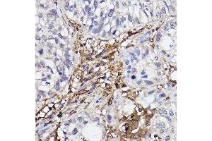 Immunohistochemistry of paraffin-embedded human lung cancer using GBP1 Rabbit mAb (ABIN7267549) at dilution of 1:100 (40x lens).