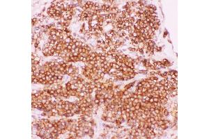 Anti-NFkB p105/P50 Picoband antibody,  IHC(P): Human Lung Cancer Tissue (NFKB1 anticorps  (AA 1-360))