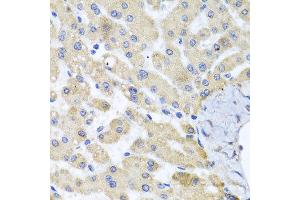 Immunohistochemistry of paraffin-embedded human liver injury using ABCB8 antibody at dilution of 1:100 (x40 lens). (ABCB8 anticorps)