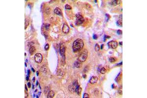 Immunohistochemical analysis of Nucleophosmin staining in human breast cancer formalin fixed paraffin embedded tissue section.