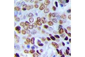 Immunohistochemical analysis of POLR3E staining in human prostate cancer formalin fixed paraffin embedded tissue section.