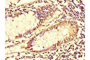 Immunohistochemistry of paraffin-embedded human colon cancer using ABIN7173699 at dilution of 1:100 (TUBG1 anticorps  (AA 29-184))