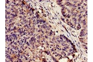 Immunohistochemistry analysis of human ovarian cancer using ABIN7163528 at dilution of 1:100 (SERPINA5 anticorps  (AA 157-367))