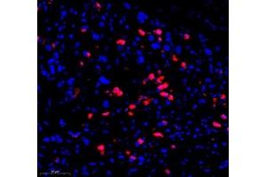 Immunofluorescence of paraffin embedded human gastric cancer using CD307 (ABIN7073931) at dilution of 1:1200 (300x lens) (FCRL5 anticorps)