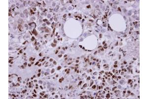 IHC-P Image Immunohistochemical analysis of paraffin-embedded CL1-0 xenograft, using Laforin, antibody at 1:100 dilution. (EPM2A anticorps  (C-Term))