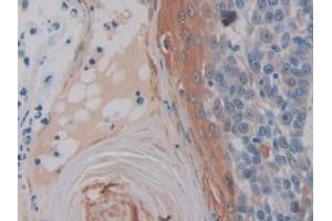 Detection of CELSR3 in Human Skin cancer Tissue using Polyclonal Antibody to Cadherin EGF LAG Seven Pass G-Type Receptor 3 (CELSR3)