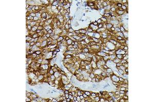 Immunohistochemistry of paraffin-embedded human mammary cancer using FCGR1B antibody (ABIN7267161) at dilution of 1:100 (40x lens). (FCGR1B anticorps)