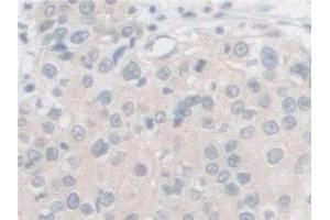 Detection of PCSK1 in Human Prostate cancer Tissue using Polyclonal Antibody to Proprotein Convertase Subtilisin/Kexin Type 1 (PCSK1)