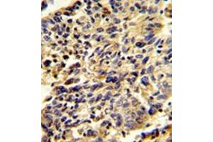 Immunohistochemistry analysis in formalin-fixed and paraffin-embedded human lung carcinoma reacted with Glypican-1 / GPC1Antibody (N-term) followed which was peroxidase-conjugated to the secondary antibody, followed by DAB staining. (GPC1 anticorps  (N-Term))