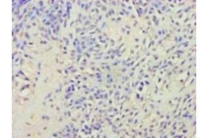 Immunohistochemistry of paraffin-embedded human breast cancer using ABIN7175416 at dilution of 1:100 (Vasopressin anticorps  (AA 126-164))