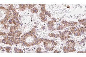 ABIN6272719 at 1/100 staining Human liver cancer tissue by IHC-P. (OR2B3 anticorps  (Internal Region))