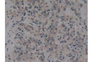 DAB staining on IHC-P; Samples: Human Prostate cancer Tissue