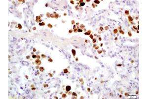 Formalin-fixed and paraffin embedded human lung carcinoma labeled with Anti-Granzyme B Polyclonal Antibody, Unconjugated (ABIN675354) at 1:200 followed by conjugation to the secondary antibody and DAB staining (GZMB anticorps  (AA 21-130))