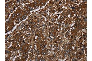 The image on the left is immunohistochemistry of paraffin-embedded Human liver cancer tissue using ABIN7191233(KLRF1 Antibody) at dilution 1/30, on the right is treated with synthetic peptide.