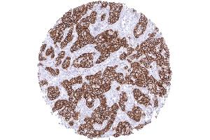 Breast Strong membranous E cadherin staining in a breast cancer NST