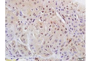 Formalin-fixed and paraffin embedded human laryngeal carcinoma labeled with Anti Phospho-cdc2 (Tyr15) Polyclonal Antibody, Unconjugated (ABIN684013) at 1:200 followed by conjugation to the secondary antibody and DAB staining (CDK1 anticorps  (pTyr15))