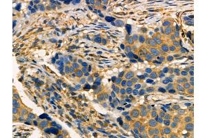 Phospho-MAP4K4 (Ser801) Antibody at 1/100 staining Human breast cancer by IHC-P. (MAP4K4 anticorps  (pSer801))
