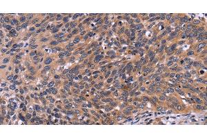 Immunohistochemistry of paraffin-embedded Human cervical cancer tissue using SPATA7 Polyclonal Antibody at dilution 1:30 (SPATA7 anticorps)