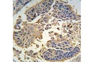 IHC analysis of FFPE human lung carcinoma tissue stained with RIPK3 antibody (RIPK3 anticorps  (AA 489-518))