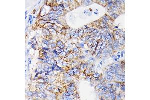 Immunohistochemistry of paraffin-embedded human colon carcinoma using Integrin alpha 2 (ITG/CD49b) (ITG/CD49b) Rabbit mAb  at dilution of 1:100 (40x lens). (ITGA2 anticorps)