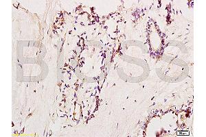 Formalin-fixed and paraffin embedded human breast carcinoma labeled with Anti-VCAM-1/CD106/L1CAM Polyclonal Antibody, Unconjugated (ABIN729838) at 1:200, followed by conjugation to the secondary antibody and DAB staining (VCAM1 anticorps  (AA 651-739))