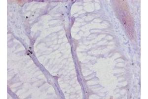 Immunohistochemistry of paraffin-embedded human colon cancer using ABIN7148231 at dilution of 1:20