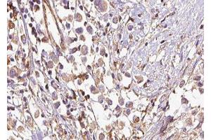 ABIN6277523 at 1/100 staining Human breast cancer tissue by IHC-P. (SGCE anticorps  (Internal Region))