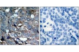 Immunohistochemistry analysis of paraffin-embedded human breast carcinoma, using ASK1 (Phospho-Ser83) Antibody.