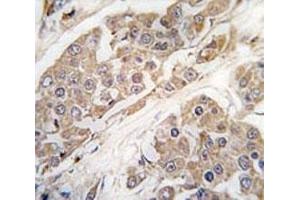IHC analysis of FFPE human breast carcinoma tissue stained with CTDSP2 antibody
