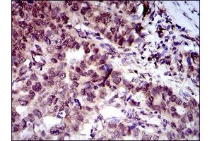 Immunohistochemical analysis of paraffin-embedded esophageal cancer tissues using CLGN mouse mAb with DAB staining. (Calmegin anticorps  (AA 249-405))