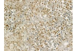 ABIN6265989 and ABIN6269137 at 1/100 staining human prostate carcinoma by IHC-P. (Vitamin D Receptor anticorps  (Internal Region))