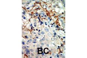 Formalin-fixed and paraffin-embedded human cancer tissue reacted with EPHA3 polyclonal antibody  , which was peroxidase-conjugated to the secondary antibody, followed by AEC staining. (EPH Receptor A3 anticorps  (N-Term))