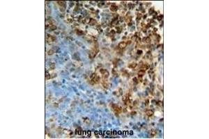 IT Antibody (N-term) (ABIN651135 and ABIN2840091) immunohistochemistry analysis in formalin fixed and raffin embedded human lung carcinoma followed by peroxidase conjugation of the secondary antibody and DAB staining.