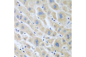 Immunohistochemistry of paraffin-embedded human liver cancer using BLVRB antibody. (BLVRB anticorps  (AA 1-206))
