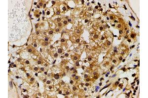 ABIN6267452 at 1/200 staining human vascular cancer tissue sections by IHC-P.