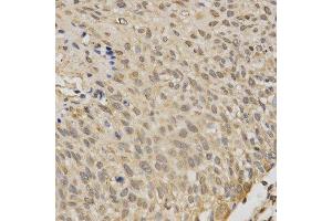 Immunohistochemistry of paraffin-embedded human esophageal cancer using STK11 antibody.