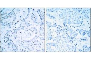 Immunohistochemistry analysis of paraffin-embedded human breast carcinoma tissue, using Estrogen Receptor-alpha (Ab-104) Antibody.