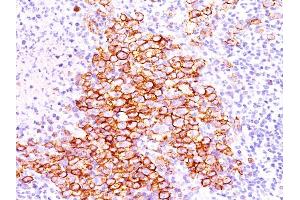 Formalin-fixed, paraffin-embedded human Hodgkin's lymphoma stained with CD30 Ab (CD30/412).