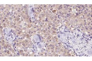 ABIN6273344 at 1/100 staining Human thyroid cancer tissue by IHC-P. (VPS11 anticorps  (Internal Region))