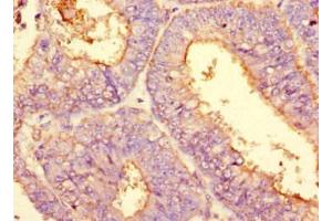 Immunohistochemistry of paraffin-embedded human melanoma using ABIN7163728 at dilution of 1:200