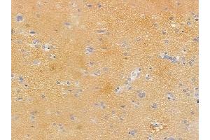 ABIN6255270 and ABIN6267406 at 1/100 staining human glioblastoma by IHC-P.