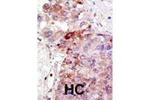 Formalin-fixed and paraffin-embedded human hepatocellular carcinoma tissue reacted with PIAS1 polyclonal antibody , which was peroxidase-conjugated to the secondary antibody, followed by DAB staining. (PIAS1 anticorps  (AA 607-637))