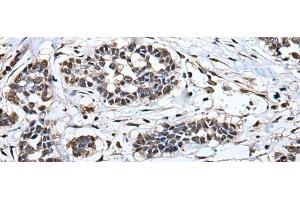 Immunohistochemistry of paraffin-embedded Human esophagus cancer tissue using HNRNPH2 Polyclonal Antibody at dilution of 1:40(x200) (HNRNPH2 anticorps)
