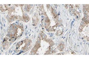 ABIN6278655 at 1/100 staining Human prostate tissue by IHC-P. (MAP3K1 anticorps  (pThr1402))