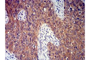 Immunohistochemical analysis of paraffin-embedded cervical cancer tissues using P2RY8 mouse mAb with DAB staining. (P2RY8 anticorps)