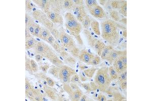 Immunohistochemistry of paraffin-embedded human liver cancer using BLVRB antibody at dilution of 1:100 (40x lens). (BLVRB anticorps)