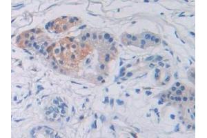 Detection of SUMF1 in Human Prostate cancer Tissue using Polyclonal Antibody to Sulfatase Modifying Factor 1 (SUMF1)