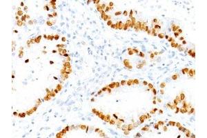 Formalin-fixed, paraffin-embedded human lung Adenocarcinoma stained with TTF1 antibody (NX2. (TTF1 anticorps)