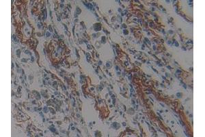 DAB staining on IHC-P; Samples: Human Lung cancer Tissue (Nischarin anticorps  (AA 1246-1346))